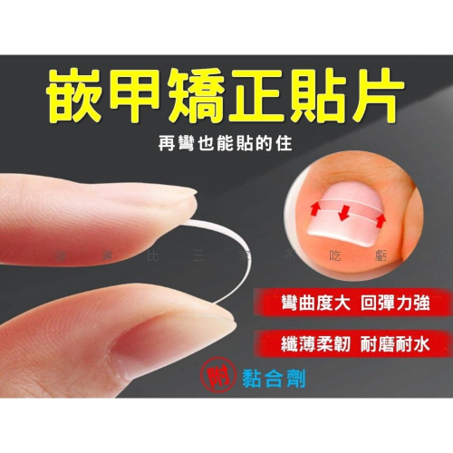 @貨比三家不吃虧@嵌甲矯正貼片 甲溝炎神器 嵌甲矯正器 凍甲貼片 指甲修護貼片 糾正指甲卷 無痕貼 正甲扣片 糾正肉包甲